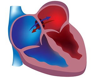 Atrial Septal Defects