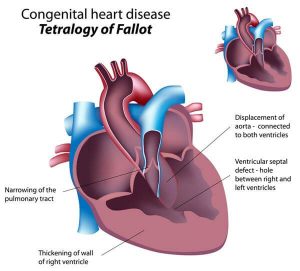 tetralogy-fallot