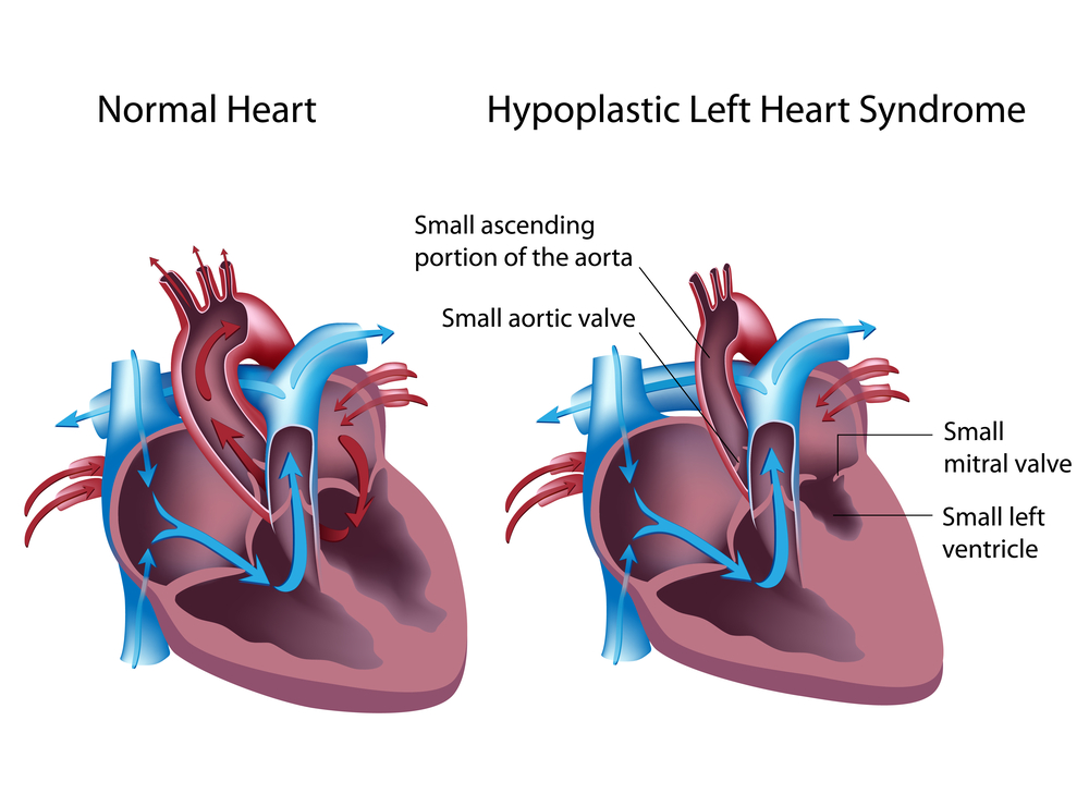 Síndrome del Corazón Izquierdo Hipoplásico
