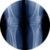 Leg bone X-ray for missed cancer diagnosis amputation case