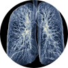 Human lungs for missed cancerous lung tumor case