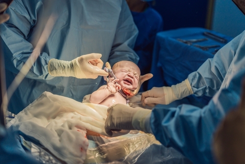 Parto de recién nacido con complicación del cordón umbilical