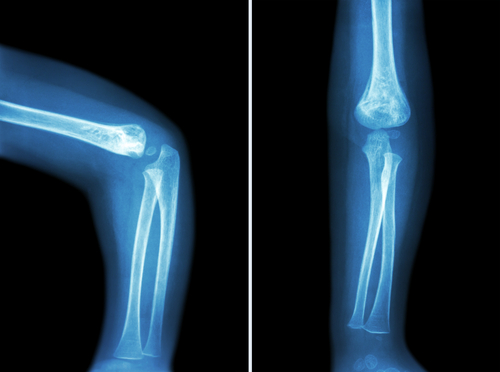 Infant arm X-ray for broken bone birth injury page