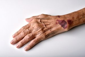 Bruised elderly arm showing possible nursing home physical abuse